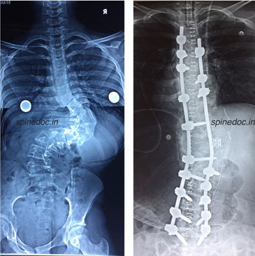 Xray of Spinal Scoliosis