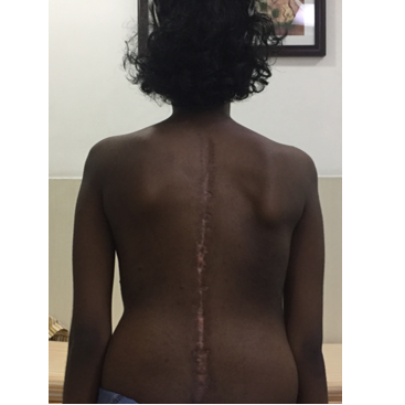 Scoliosis / Spine deformity Correction