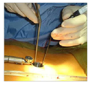 Micro lumbar surgery