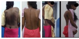 scoliosis symptoms