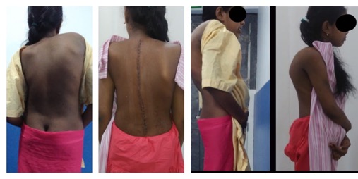scoliosis5