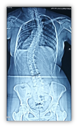 sdf scoliosis symptoms and cause