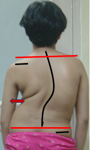sfse scoliosis spine