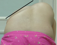 spi scoliosis surgery treatment