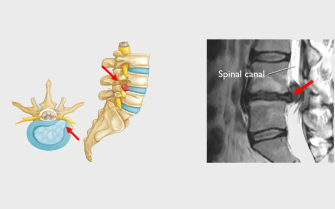 Spinal Cord Injury Health Awareness