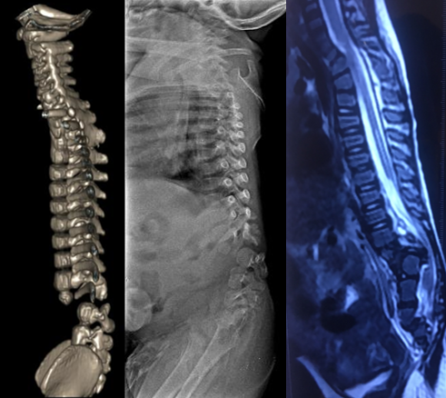 Is detethering necessary before deformity correction Dethethering by deformity correction