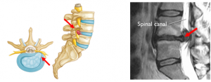 spinal canal injury health awareness