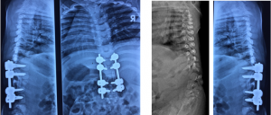 Complex spinal surgeries 