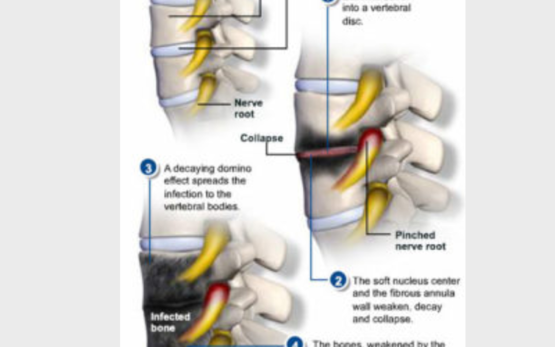 Can Spinal Infection Be the Cause of My Back Pain?