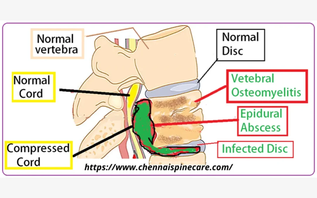 Spinal Infections Symptoms and Treatments