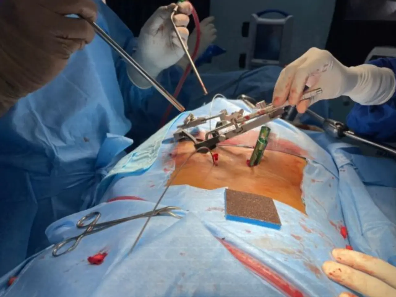 What are New Trends in Spine Surgery