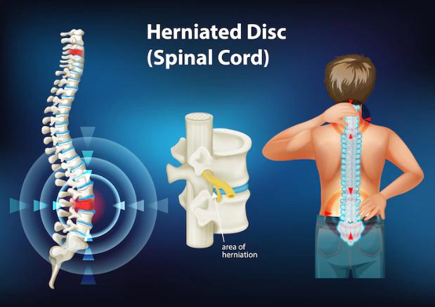spinal-disc