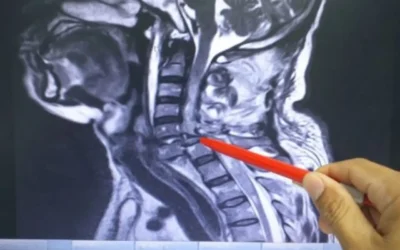What is Cervical Spine Injury?