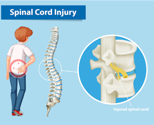Spinal-Bones-fracture