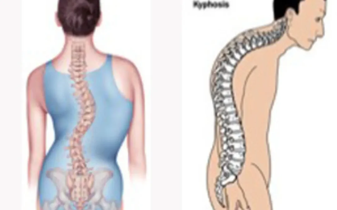 What is the treatment for Osteoporosis and Hunchback