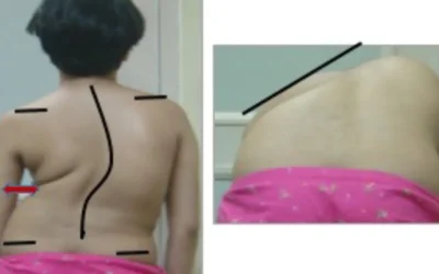 How to Know About Scoliosis in Children?
