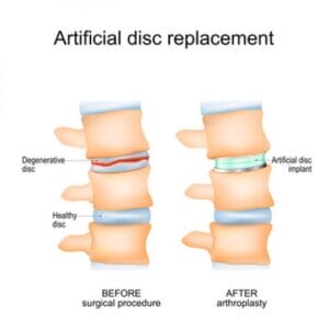 Artificial Disc Replacement Surgery