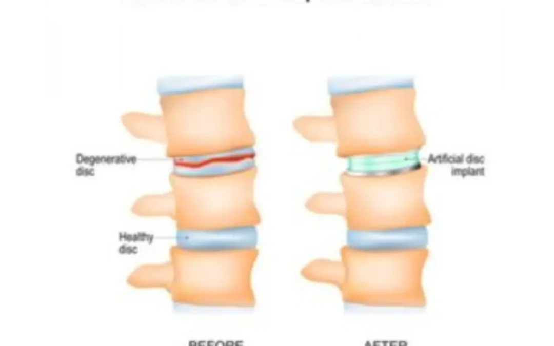 Spinal Fusion Surgery Vs Cervical Artificial Disc Replacement Surgery