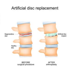 Artificial-Disc-Replacement-Surgery-300x300
