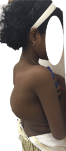 Back-deformity-Figure-2-133x300
