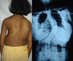 Scoliosis in Adults