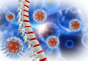 Treatment-for-Spinal-Tumours-and-Lesions-300x211