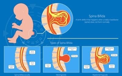 What is Genetic Disease of the Spine?