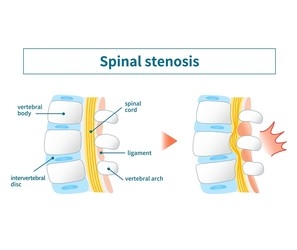 Spinal Stenosis-1