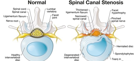 Spinal Stenosis