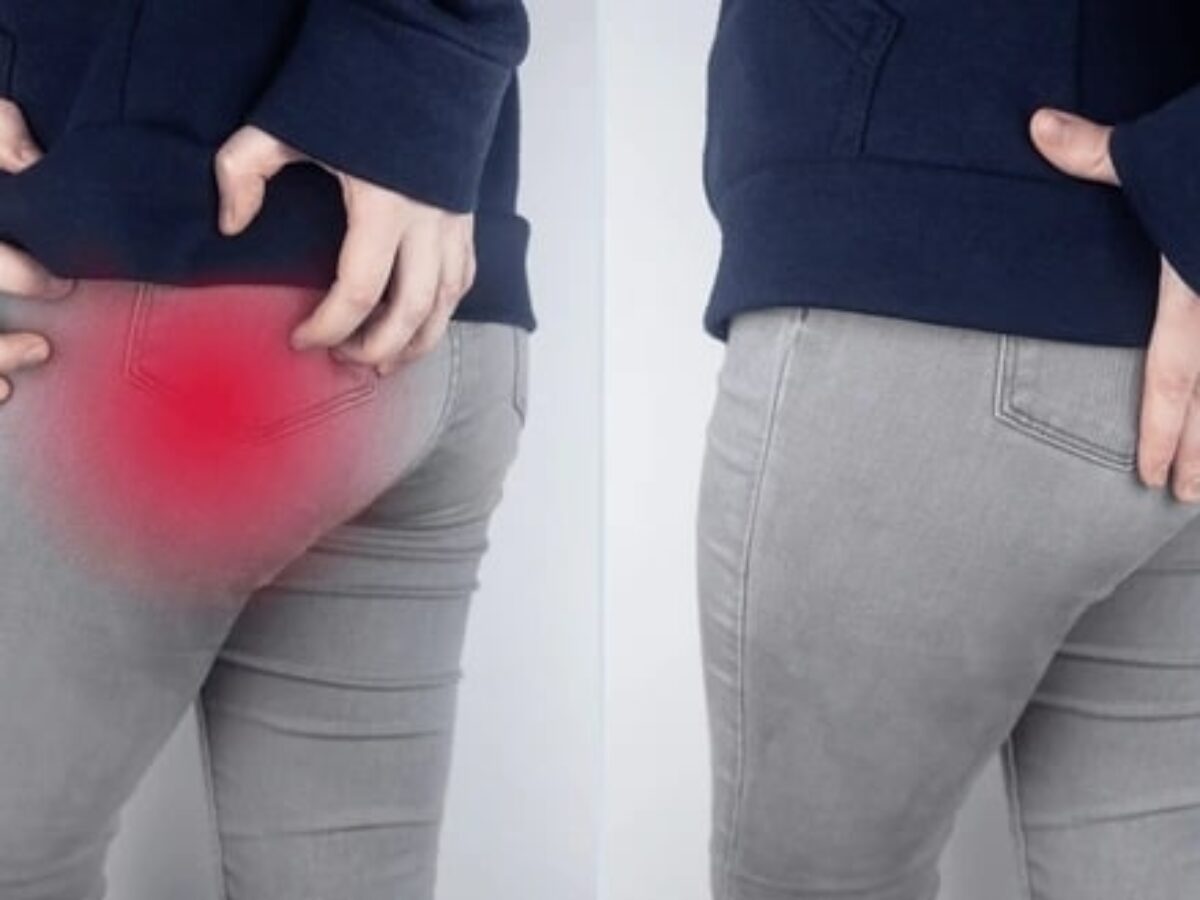 Piriformis Syndrome: Symptoms, Causes, and Treatment