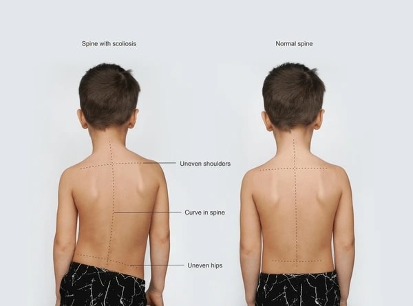 Thoracolumbar Scoliosis: Symptoms, Causes, Treatment