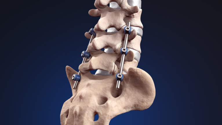 Spinal Fusion Surgery: Risks and Benefits