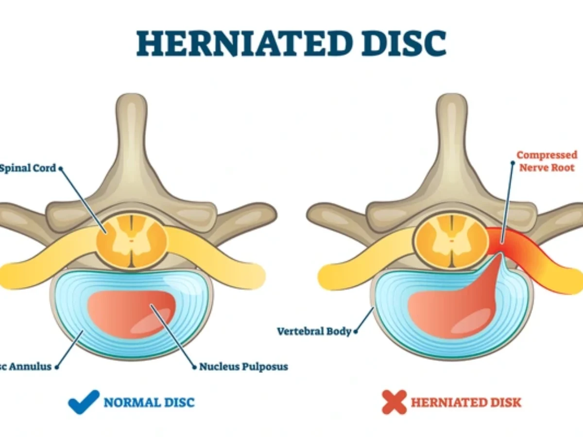 Herniated Disk New Technique Both Refills And Patches Herniated Discs