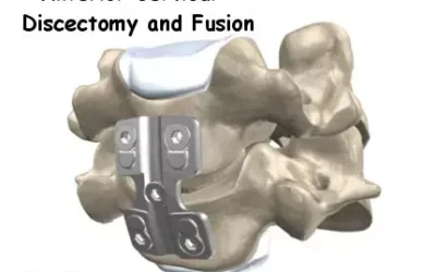 Anterior Cervical Discectomy and Fusion Surgery
