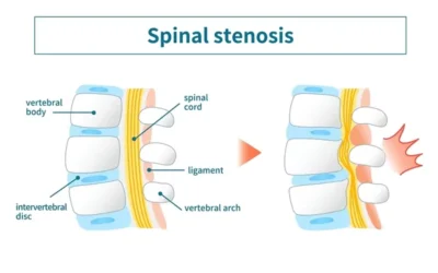 Minimally Invasive Spine Surgery for Spinal Stenosis