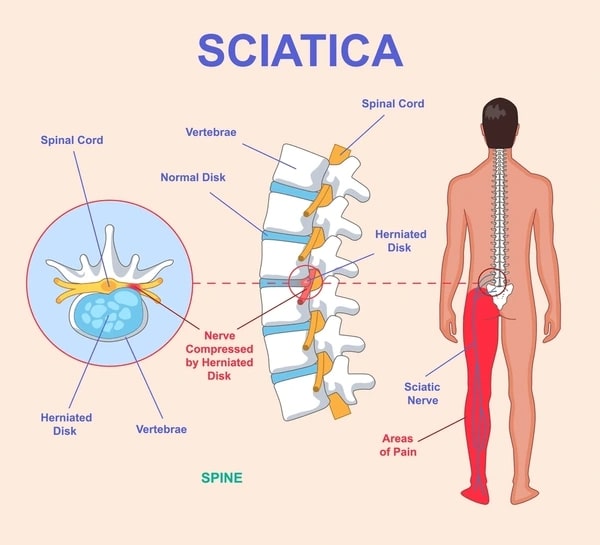 Endoscopic Spine Surgery for Sciatica