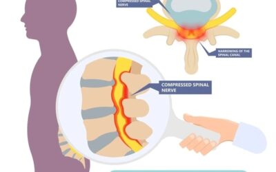 Endoscopic Spine Surgery for Spinal Stenosis
