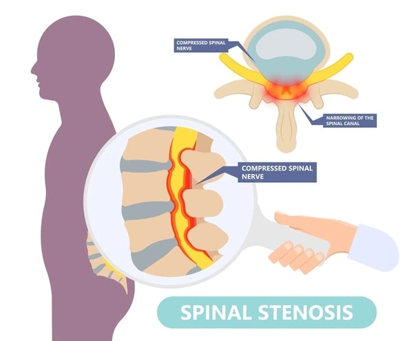 Endoscopic Spine Surgery for Spinal Stenosis