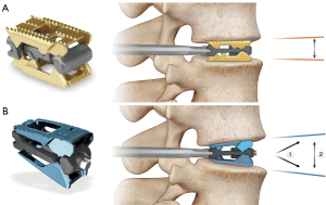 Expandable Interbody Cages in Spine Surgery
