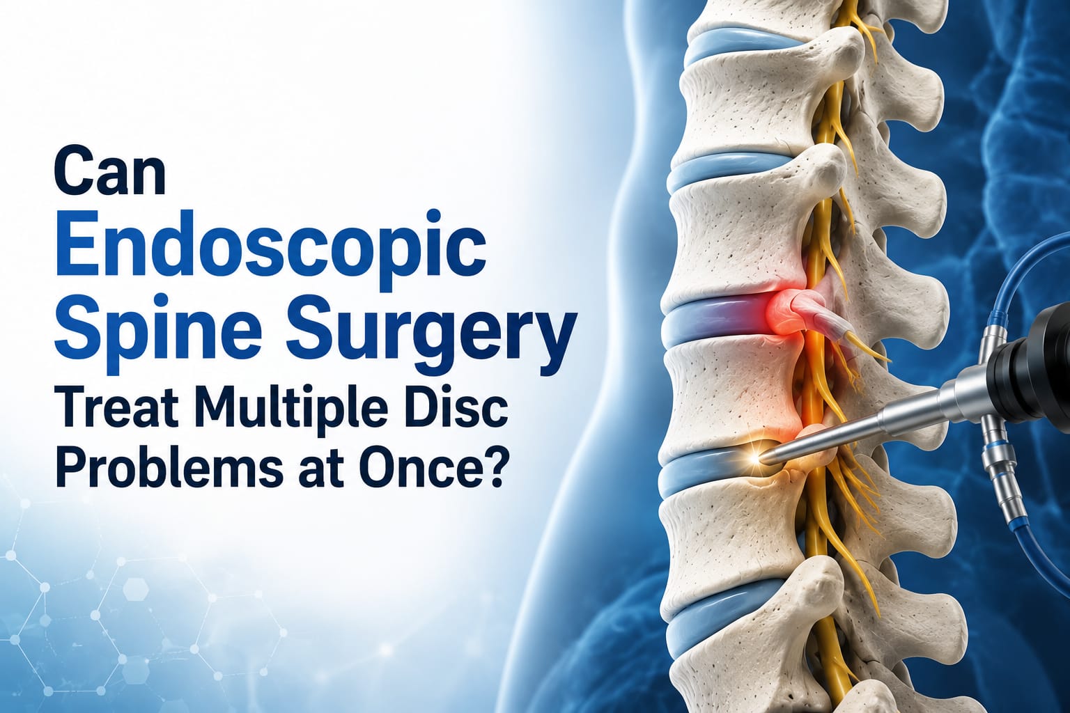Endoscopic Spine Surgery