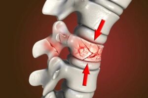 Compression fractures