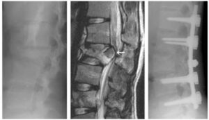 Spine Fracture Treatment 